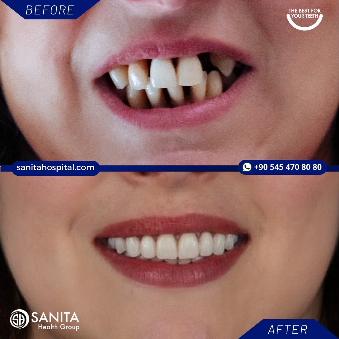 Before After 2