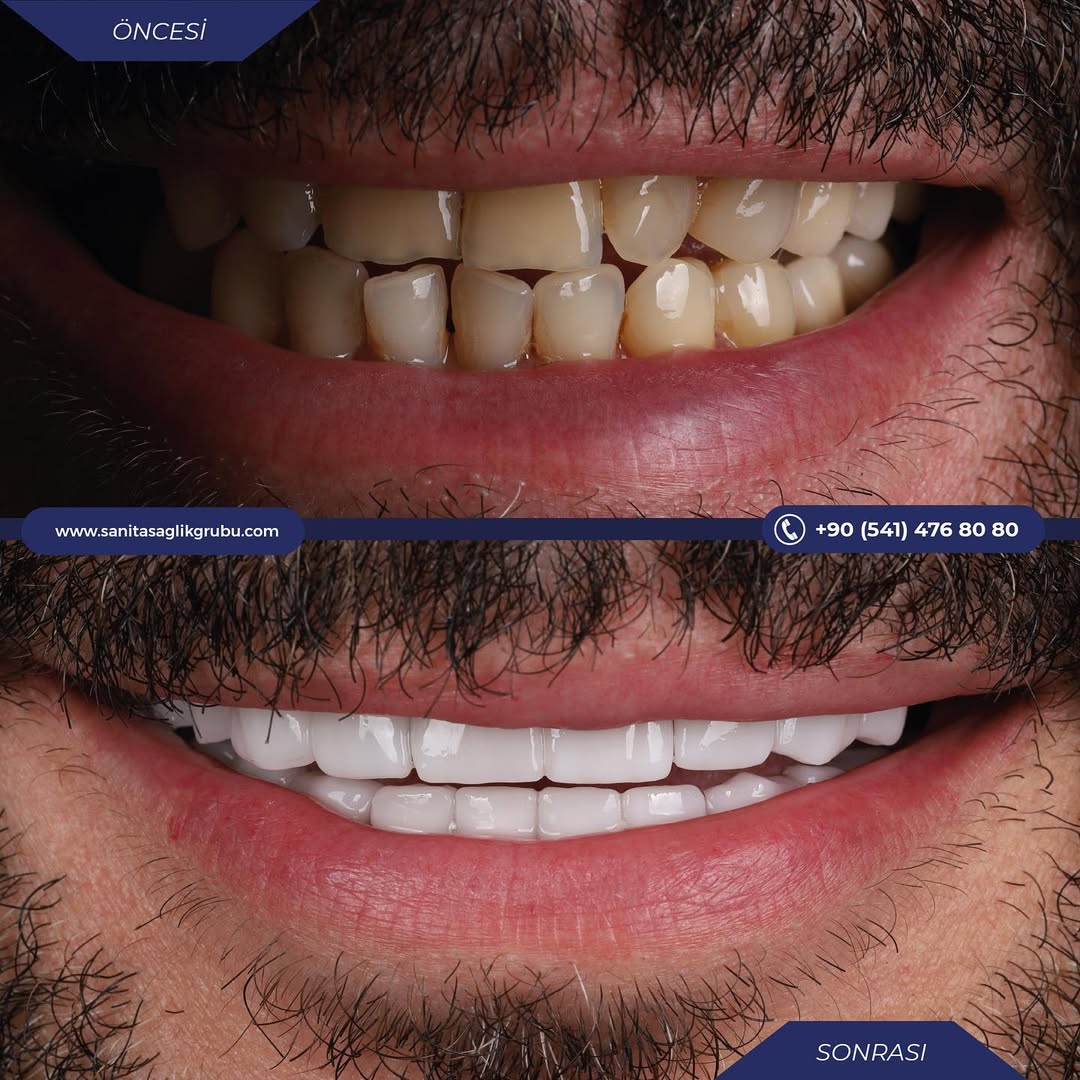 Before After 3