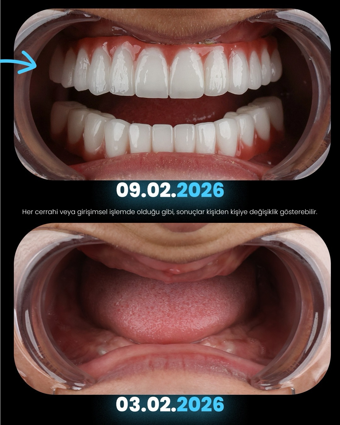 Before After 4