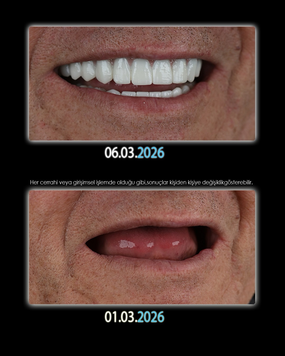 Before After 3