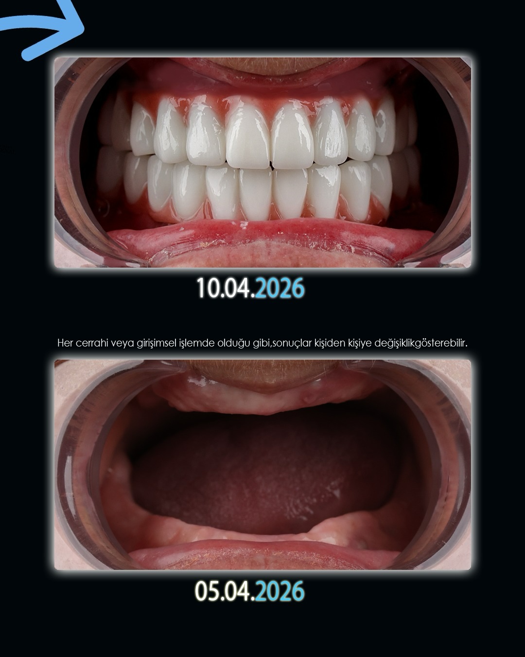 Before After 1