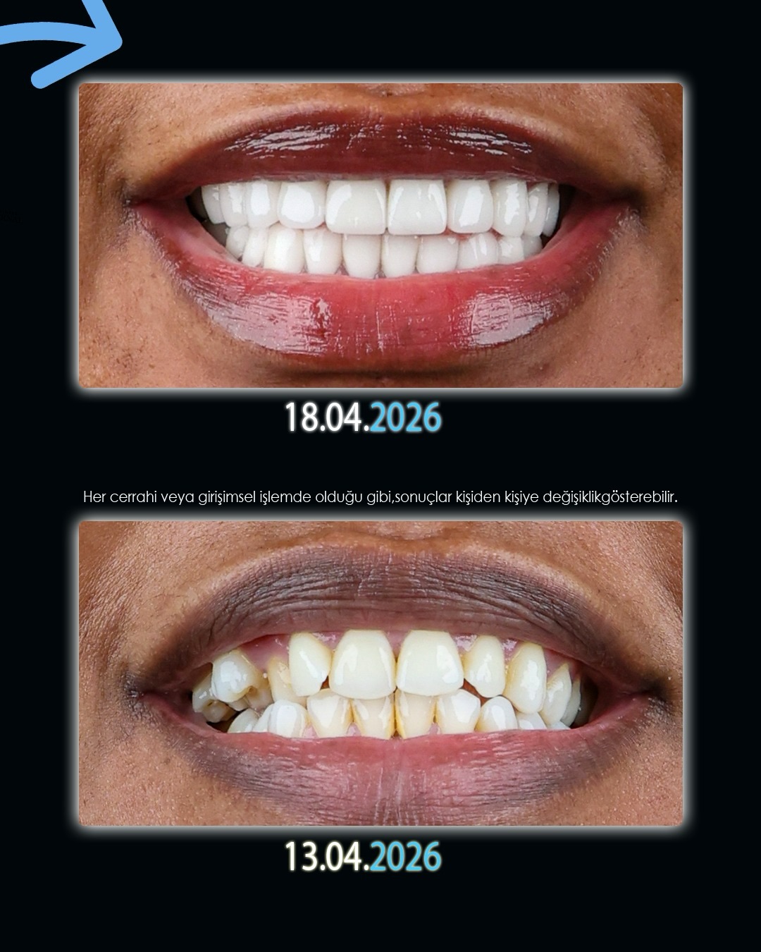 Before After 2