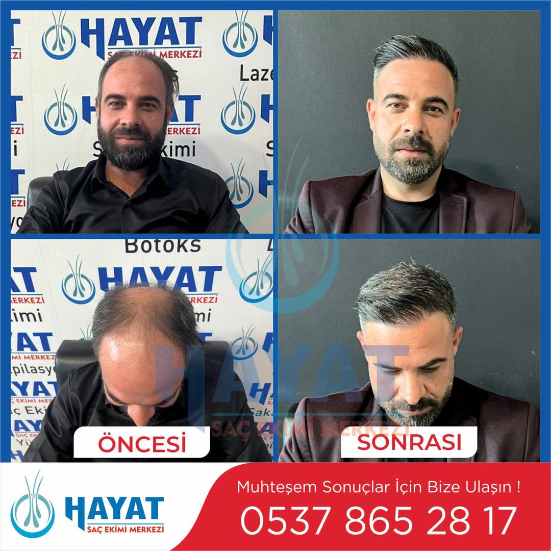 Before After 2