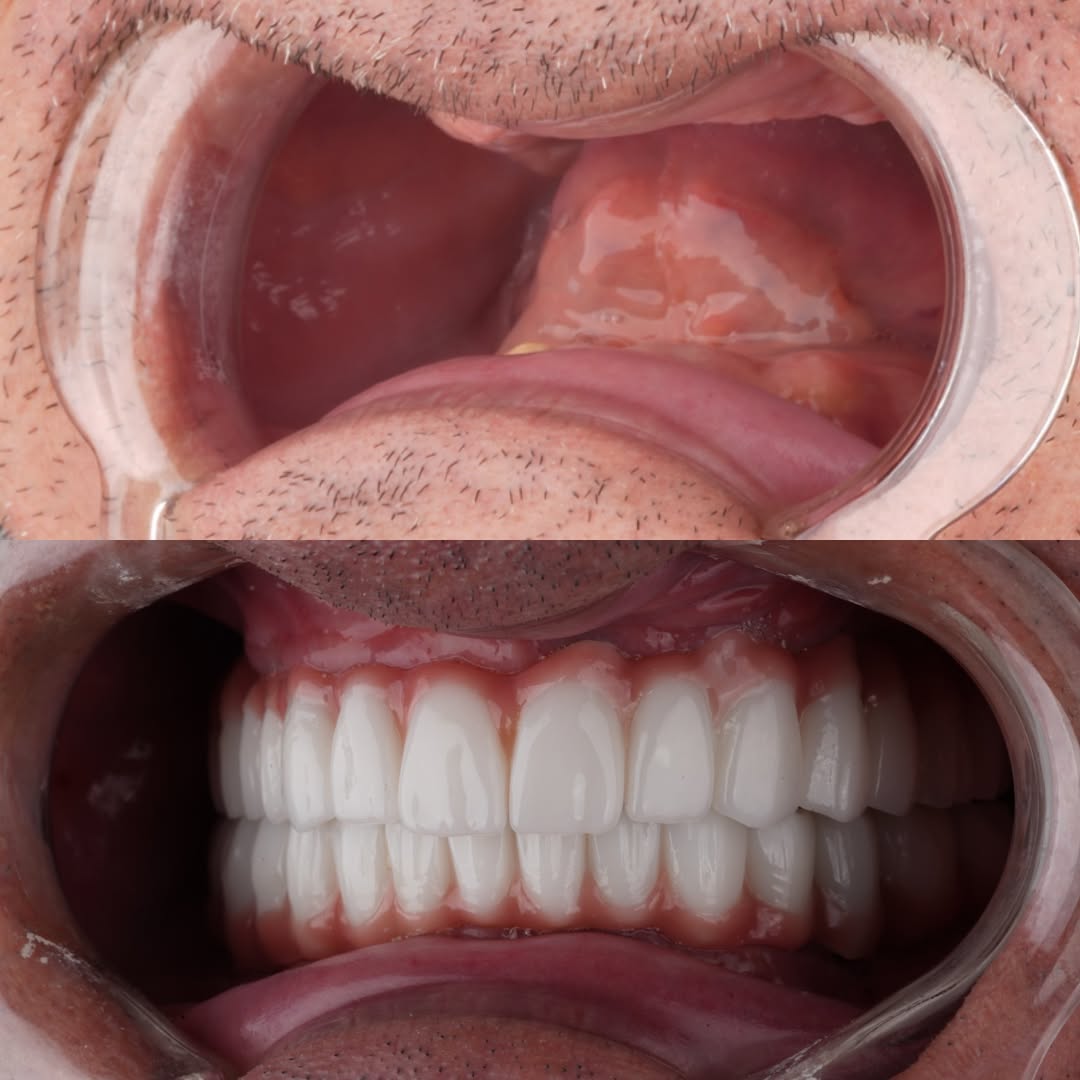 Before After 3