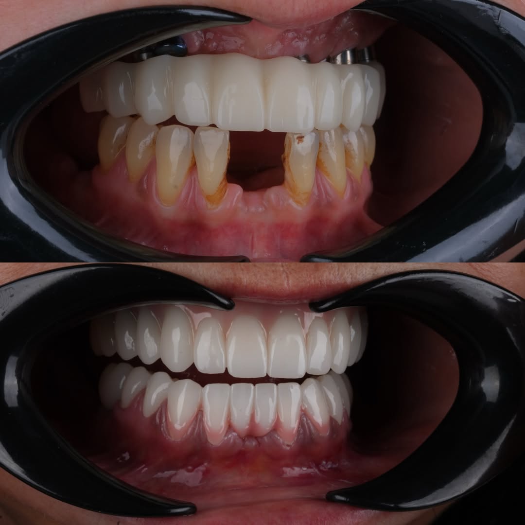 Before After 2