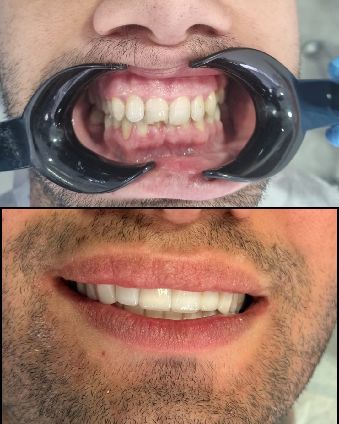 Before After 2