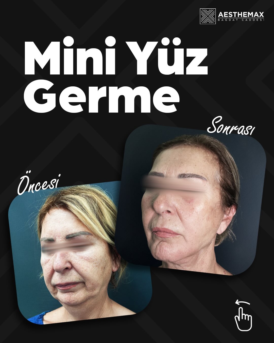 Before After 3