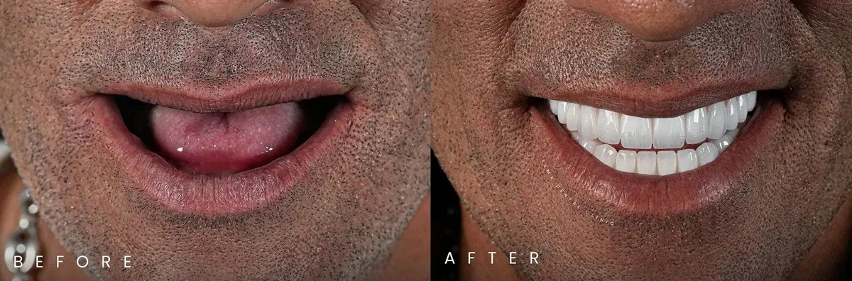 Before After 1