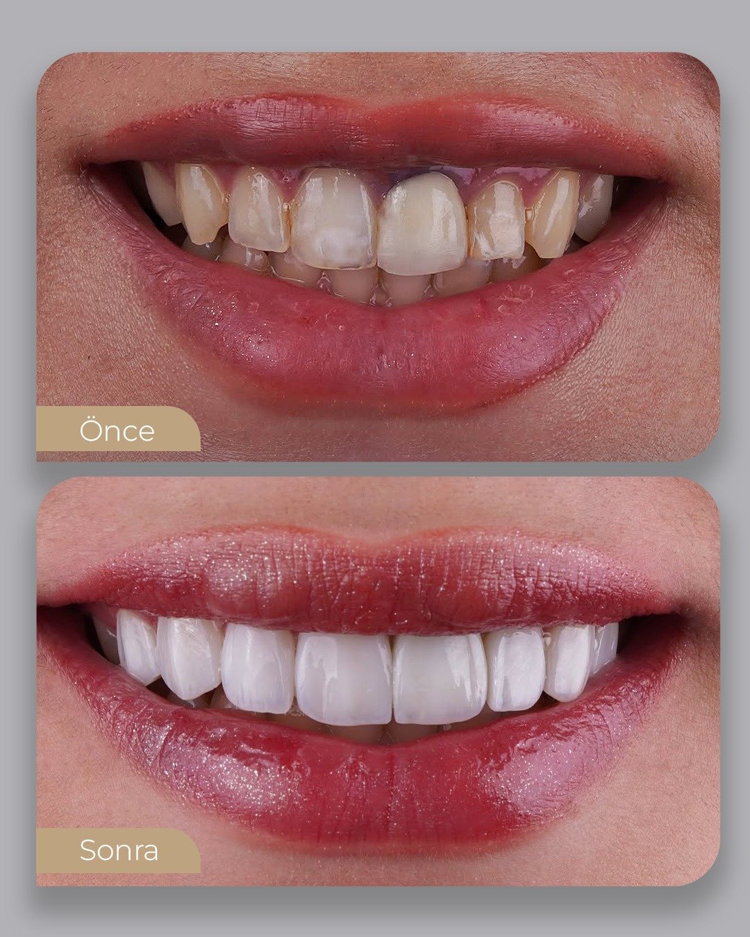 Before After 1