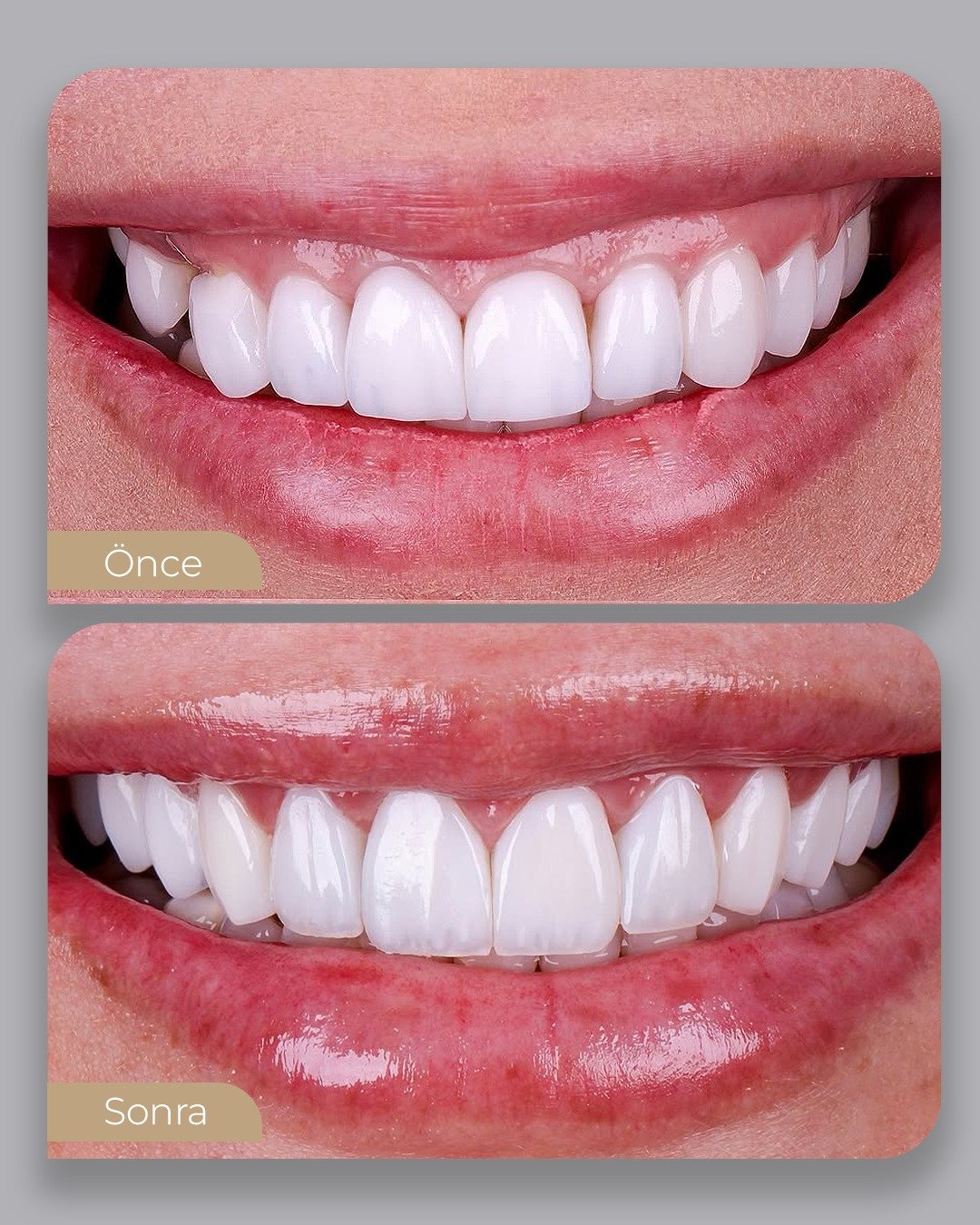 Before After 2