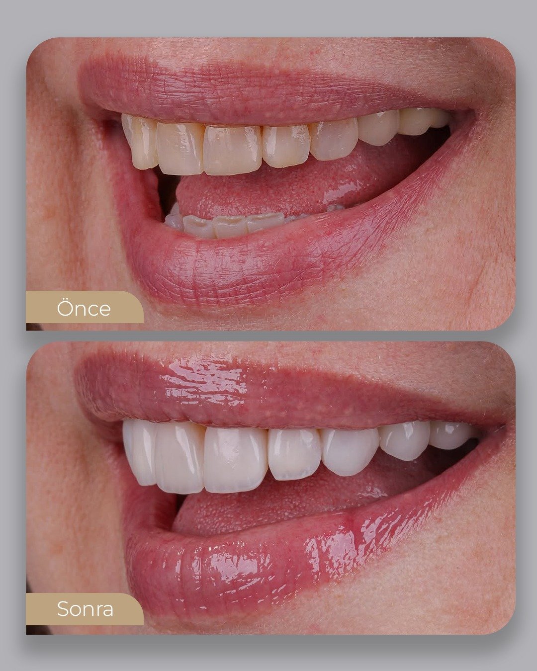 Before After 3
