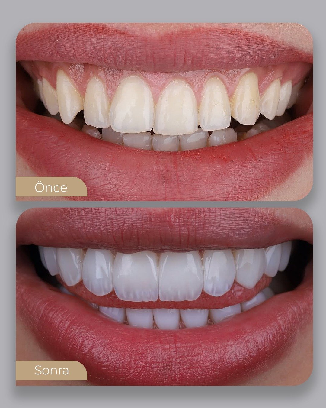 Before After 4