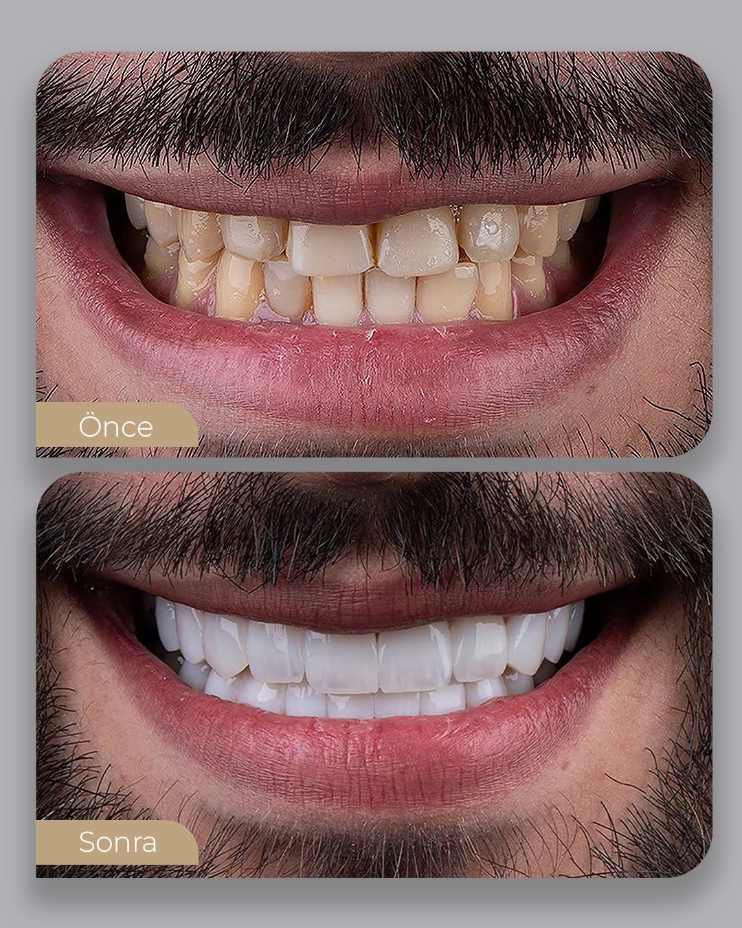 Before After 5