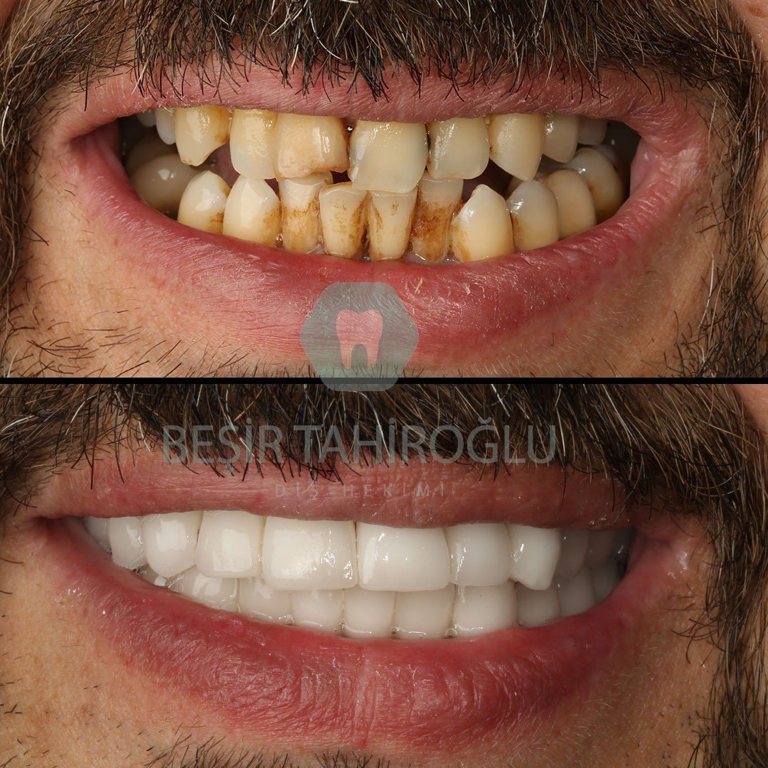 Before After 3