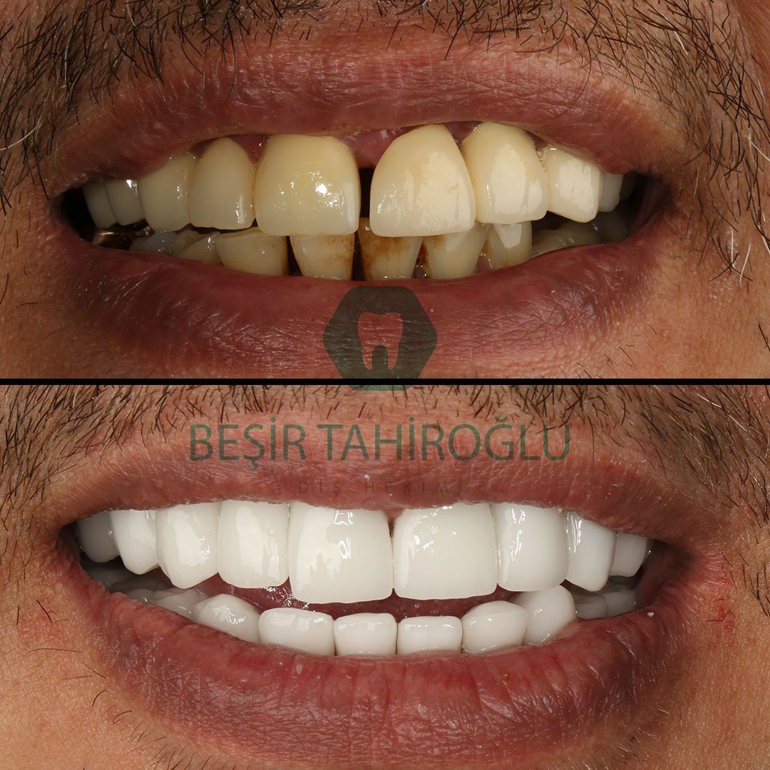 Before After 2