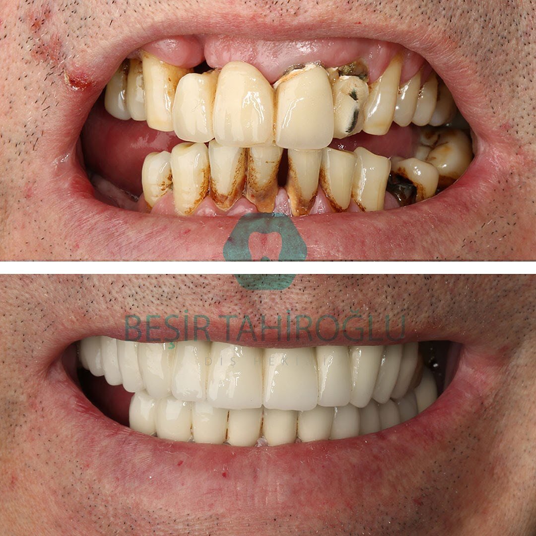 Before After 4