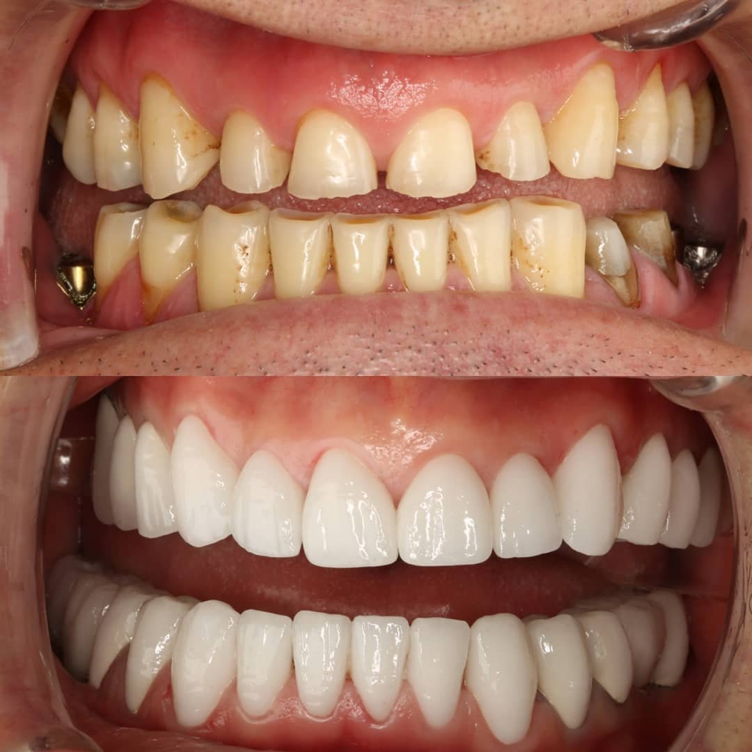 Before After 1