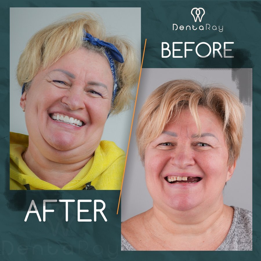 Before After 2