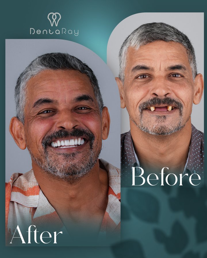 Before After 1
