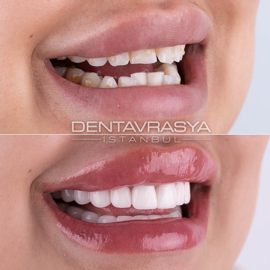 Before After 4