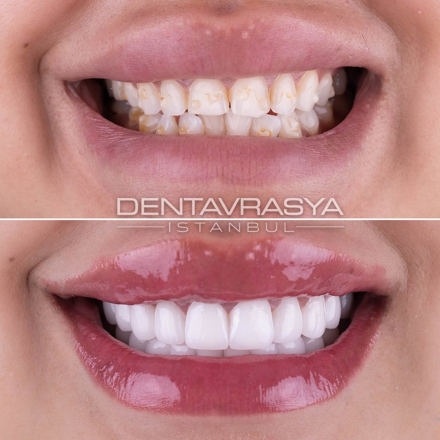Before After 3