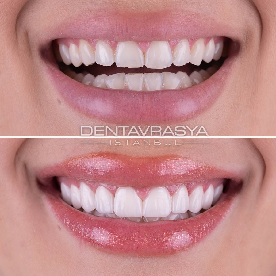 Before After 2