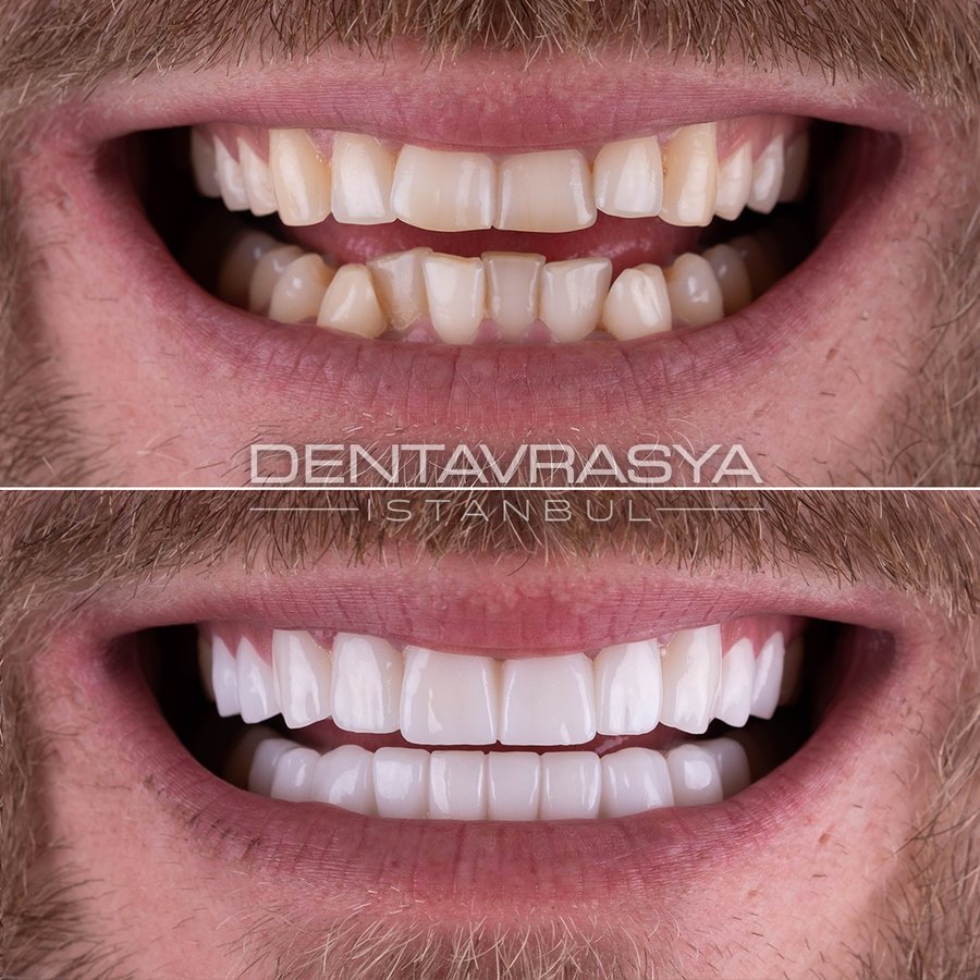 Before After 1