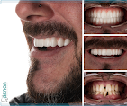 Before After 3
