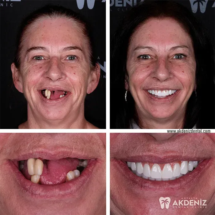 Before After 1