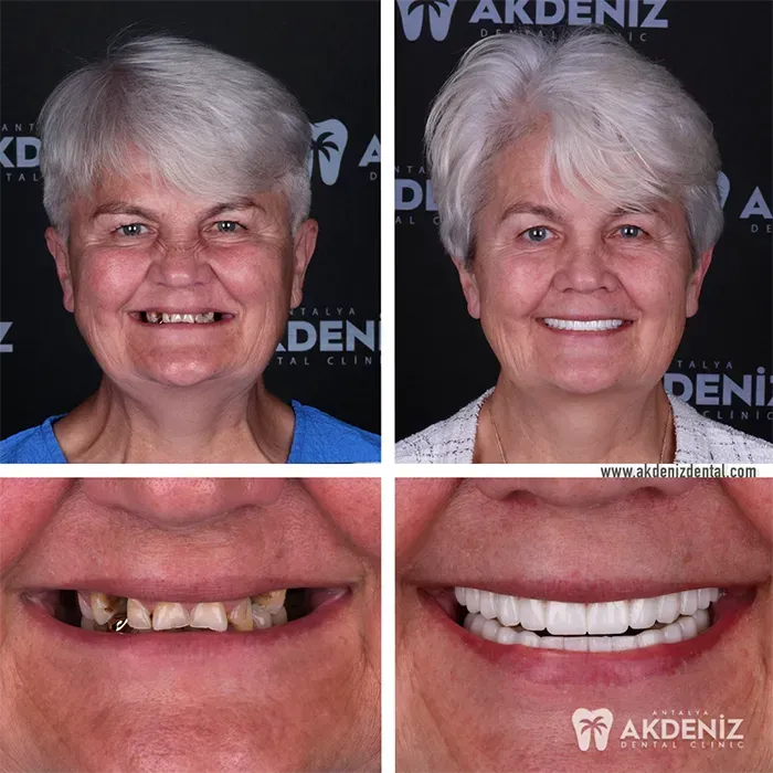 Before After 2