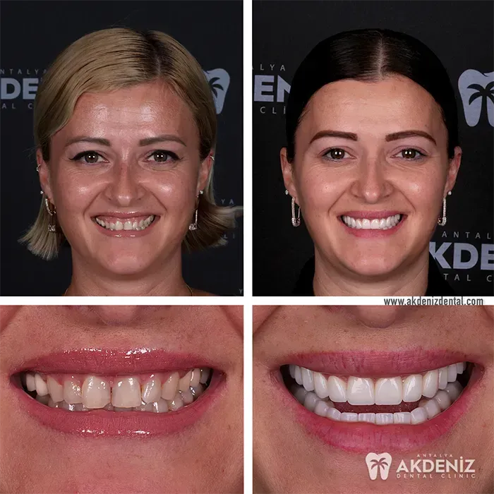 Before After 3
