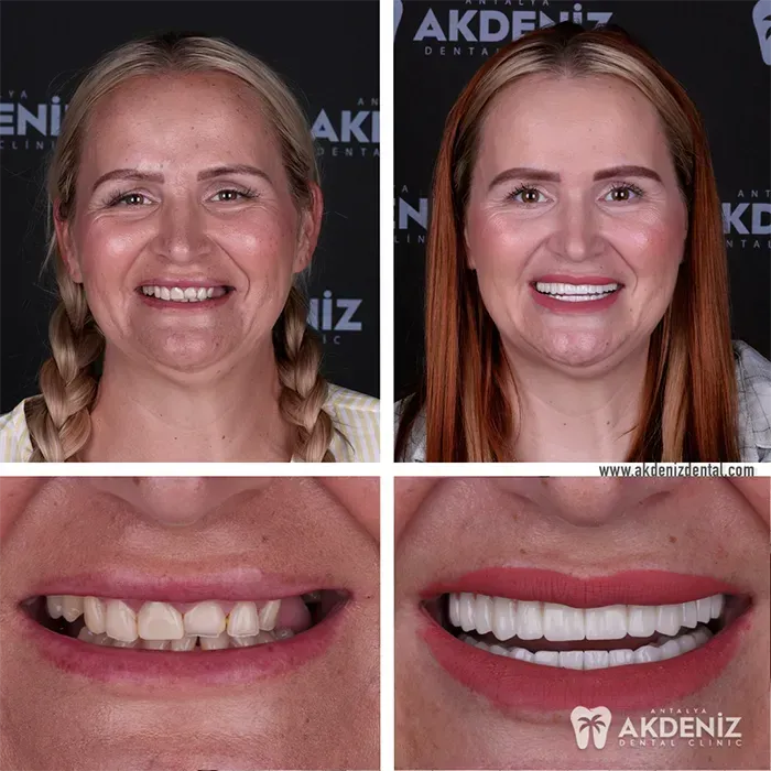 Before After 4