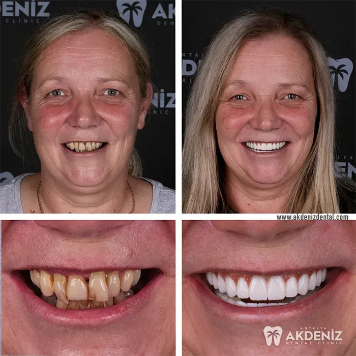 Before After 5