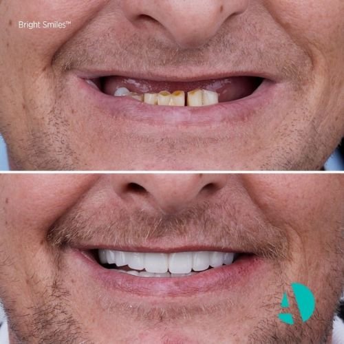 Before After 1