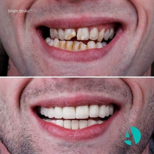 Before After 3