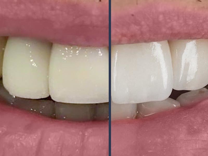 Before After 1
