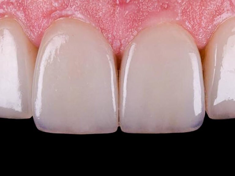 E-max laminate veneer result at Clinic Prime Istanbul