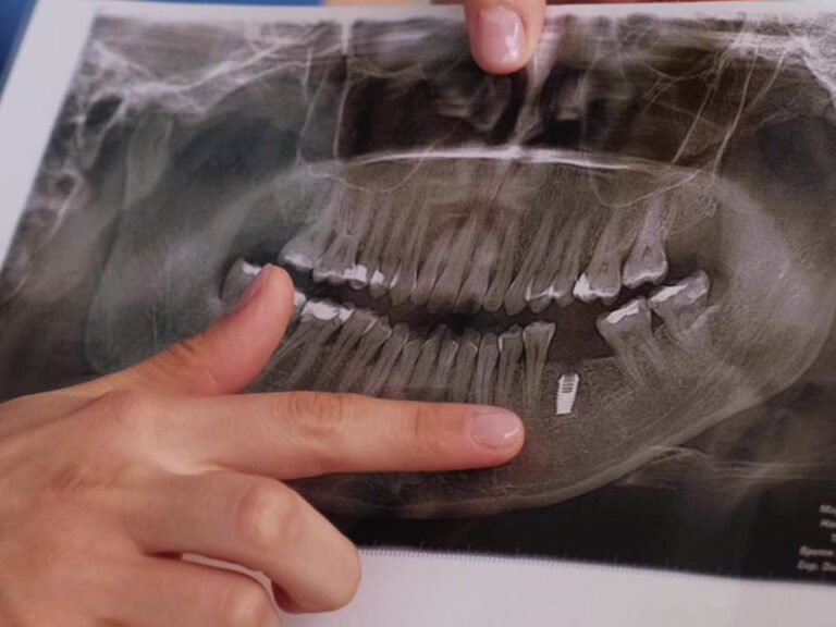 Dental implant planning at Clinic Prime Istanbul