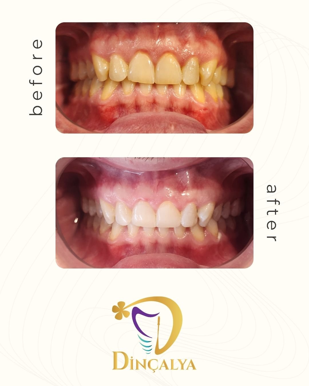 Before After 1
