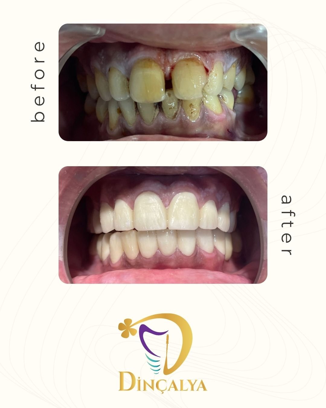 Before After 2