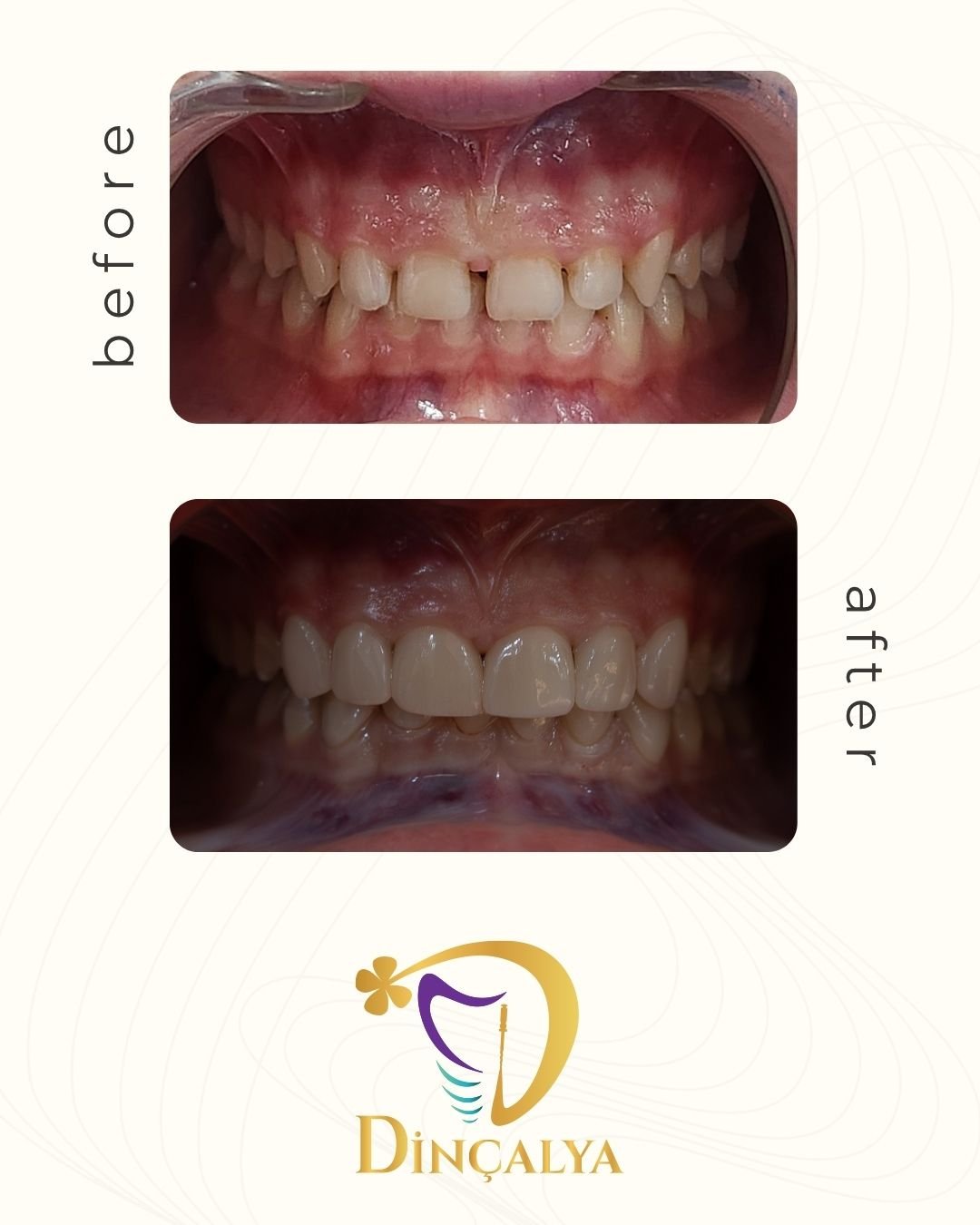 Before After 3