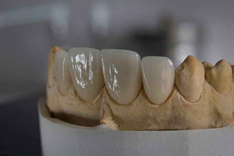 Dental veneer and crown restorations on a model — how long veneers last depends on material and care