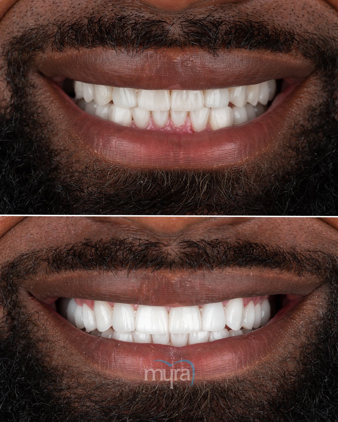 Before After 1