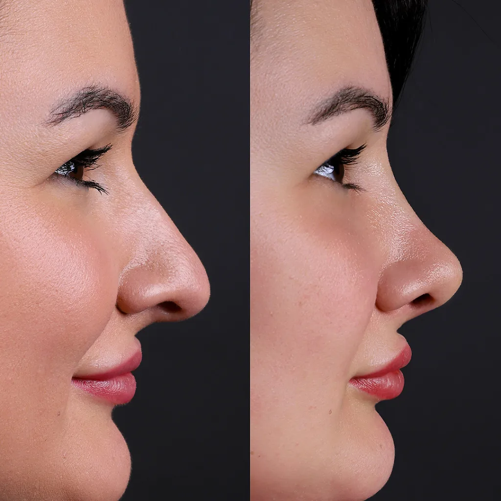 Before After 3