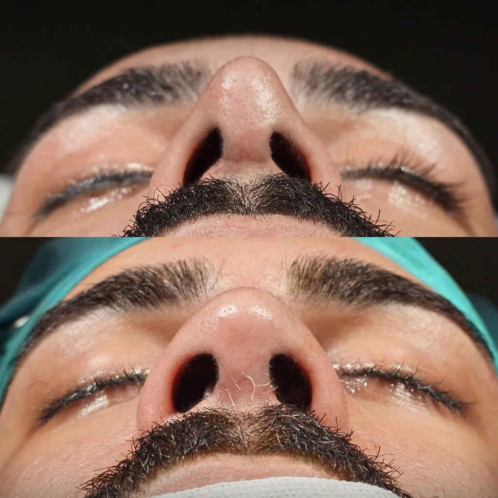 Before After 2