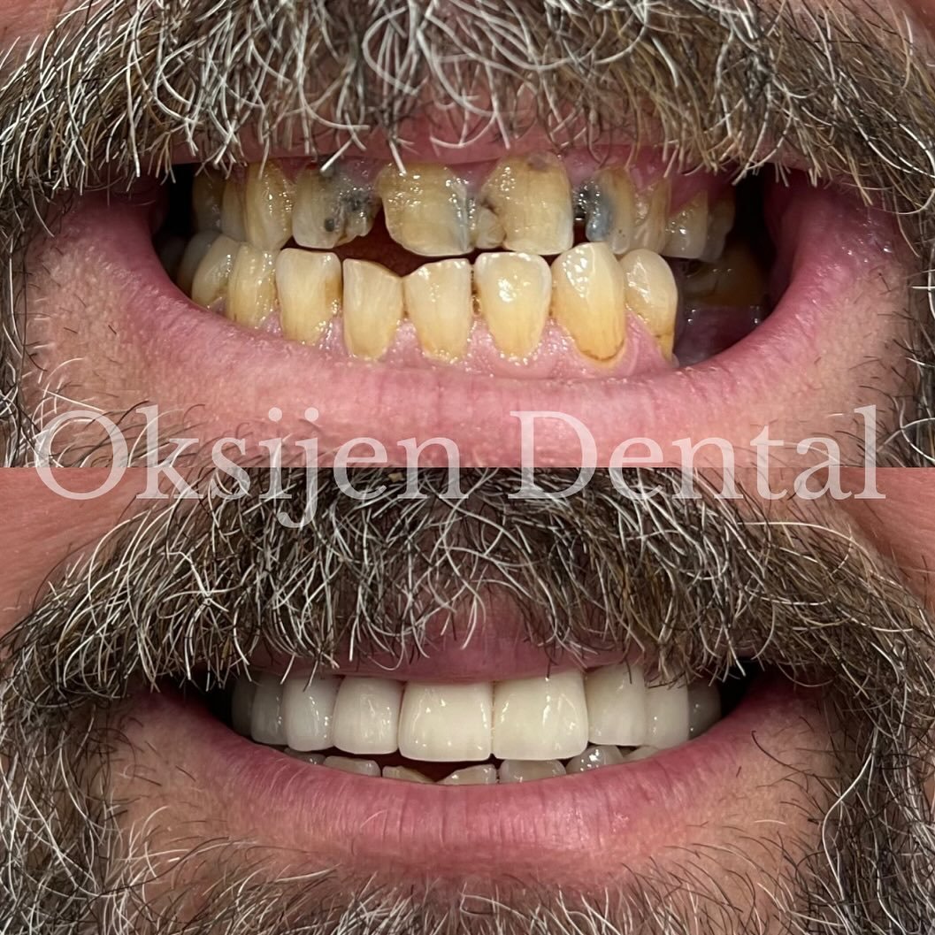 Before After 1
