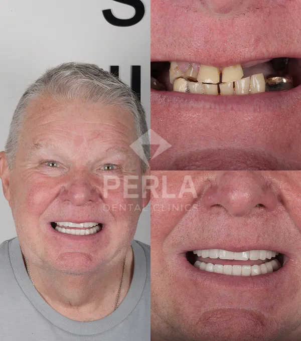 Before After 1
