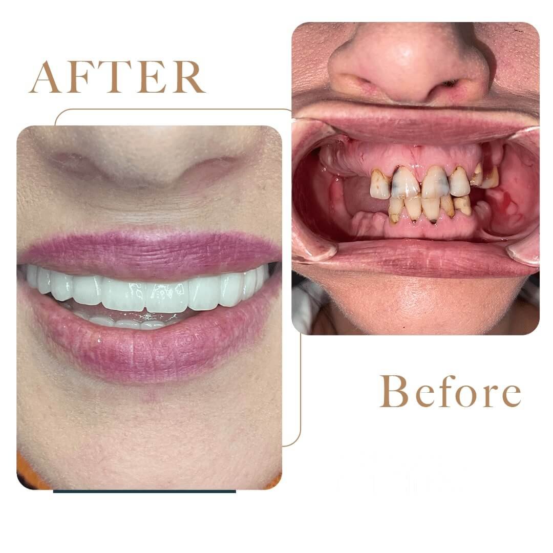 Before After 1