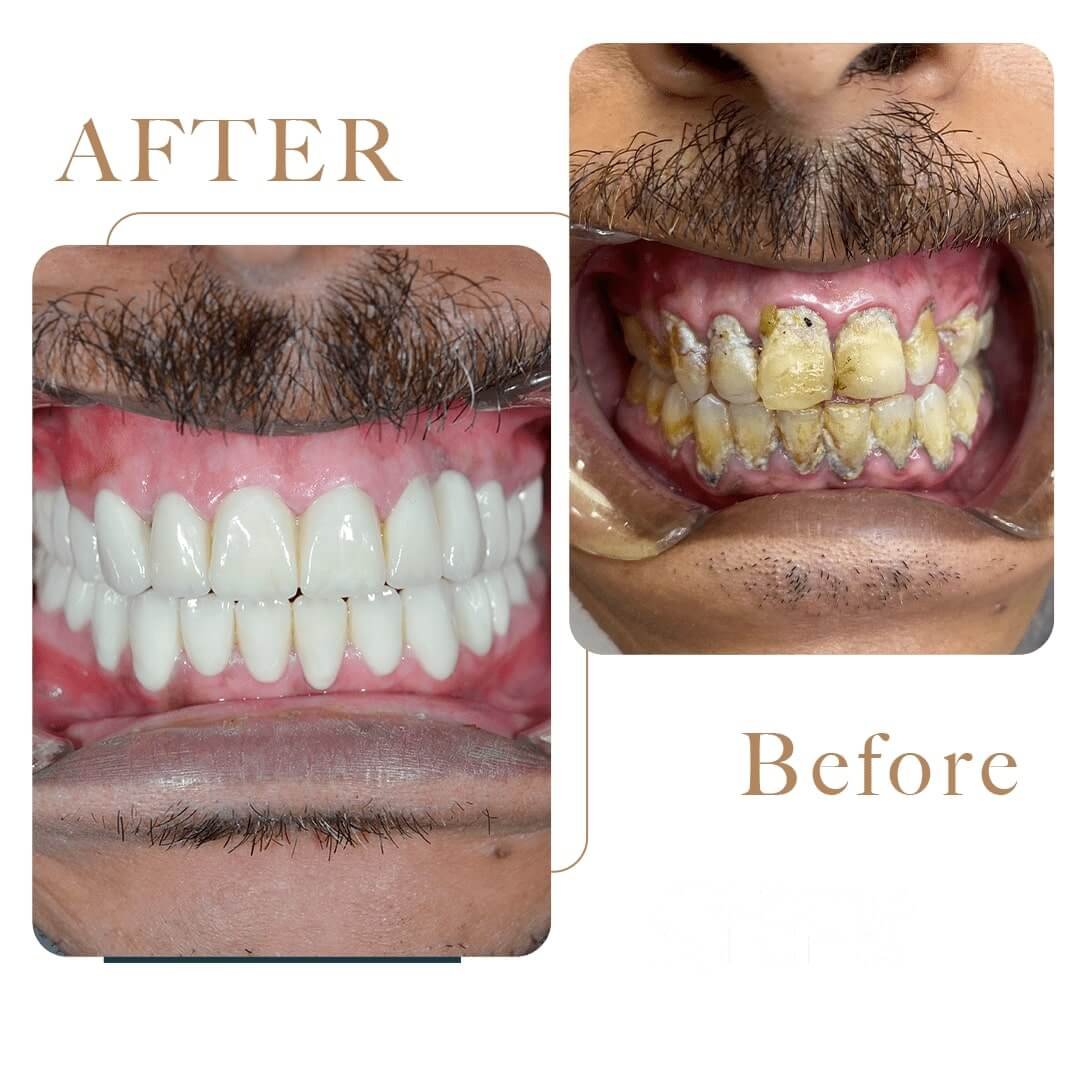 Before After 2