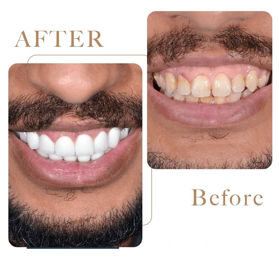 Before After 3